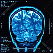 Brain MRI