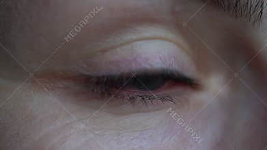 Girl with irritated dry red eye or allergy. Female suffering from redness. Conjunctivitis, keratitis