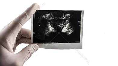 Prostate ultrasound scan on isolated white background, picture of the prostate at the doctor`s hand. Prostata place for text