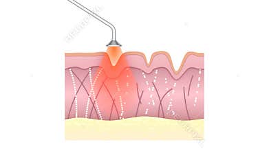Wrinkle and acne treatment. Laser skin resurfacing procedure.