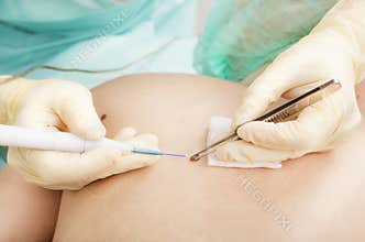Dermatologist removes a mole radio wave electrocoagulation method.