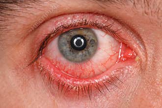 Chronic conjunctivitis eye
