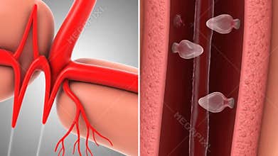 Blood Clot Formation in Artery Visualization of Blood Cells Aggregation and Thrombosis Process for Medical Education