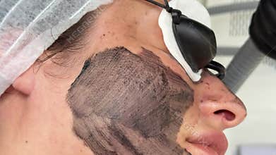Young woman getting carbon laser facial at beauty clinic. Professional skincare