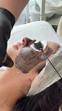 Young woman getting carbon laser facial at beauty clinic. Professional skincare