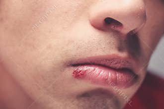 Man with cold sore