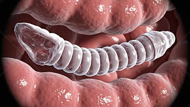 Detailed 3D Medical Animation of Tapeworm Infection Inside Human Intestines with Segmented Parasite and Pinkish Mucosal Lining