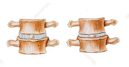 Spine - Cushioning Function of Intervertebral Discs