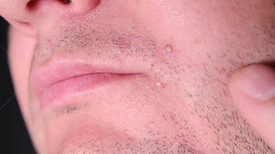 Man squeezing pimples on his unshaven face