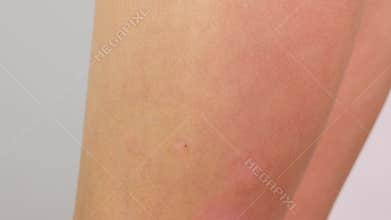 Close up leg affected by atopic dermatitis. Redness of the skin with allergies