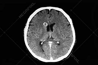 CT scan of a patient with brain abscess