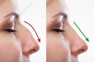 Woman`s Nose Before And After Plastic Surgery