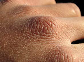 Dry skin