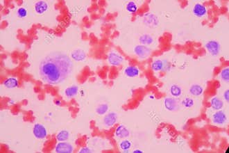 Leukemia