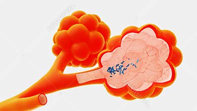 Tuberculosis into the lungs
