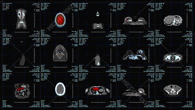 Magnetic Resonance Imaging Scan Monitor