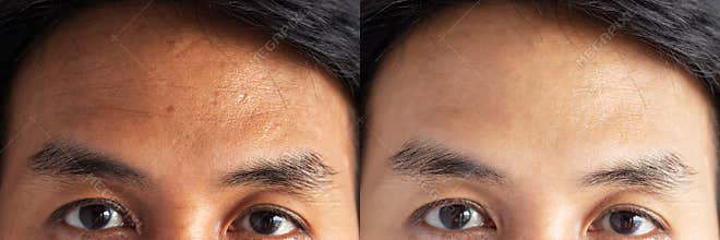 Two pictures compared effect Before and After treatment. skin with problems of freckles , pore , dull skin and wrinkles