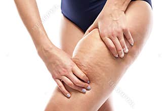 Cellulite on female legs.