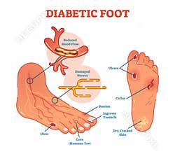 Diabetic foot medical vector illustration scheme.