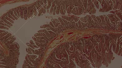 Peuz-Jaeger polyp growth at high magnification