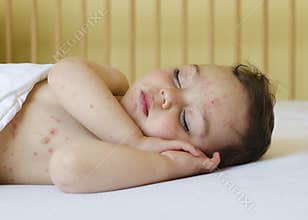 Child with chicken pox
