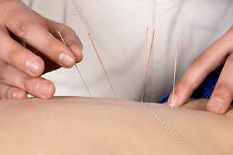 Physiotherapist doing accupuncture