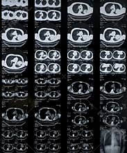 Lung cancer:CT image of chest