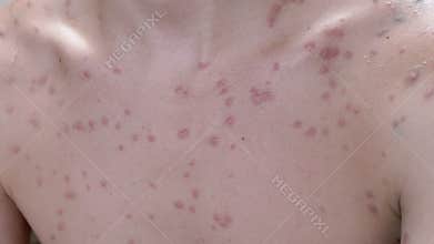 Chickenpox blisters on skin