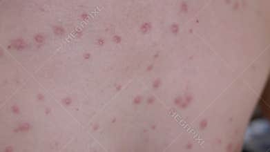 Chickenpox rash on chest