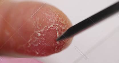 Closeup of finger with peeling skin and doctor takes scraping