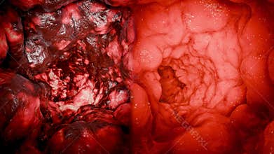 Colorectal cancer, malignant tumor in intestine, Endoscope colonoscopy, gut intestine, Colon polyp removal, inflammatory bowel