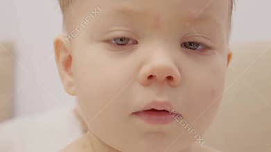 Child with early signs of chickenpox in home setting