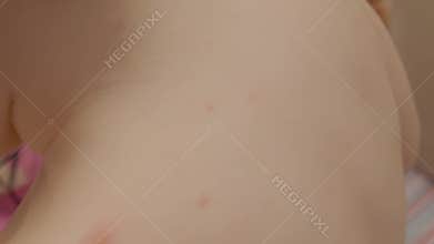 Chickenpox appears on a child's back in early stage symptoms