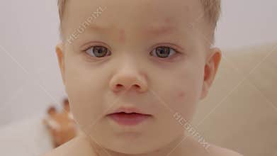 Early signs of chickenpox on child's face during home setting