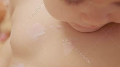 Child receives ointment for chickenpox on small red sores