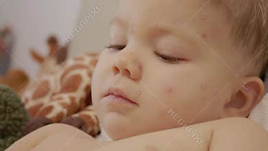 Child with chickenpox showing blisters on face at home during daytime