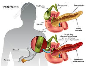 Pancreatitis