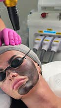 Young woman getting carbon laser facial at beauty clinic. Professional skincare