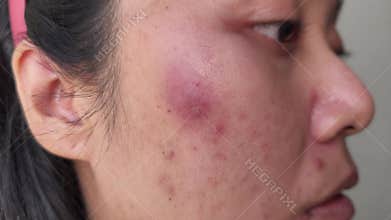 Young asian Woman face with acne. Skin Inflamed acne