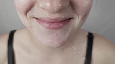 Woman with Acne Gently Smiling with Dimples