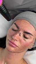 Young woman getting carbon laser facial at beauty clinic. Professional skincare