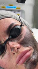 Young woman getting carbon laser facial at beauty clinic. Professional skincare