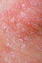 Psoriasis
