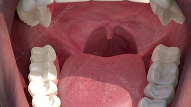 Inflammation of the tonsils with white spots stains