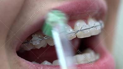 Cleaning of patient`s teeth brackets in dental clinic