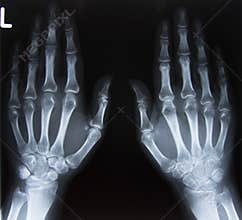 Carpal bones Human X Ray