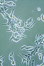 Prostate Cancer cells
