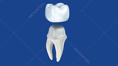 Dental crowns and tooth, 3d Concept