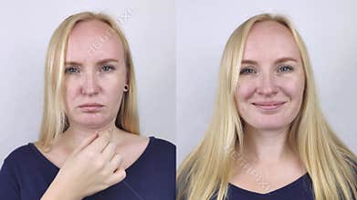 Second chin lift in women. Photos before and after plastic surgery, mentoplasty or facebuilding. Chin fat removal and face contour
