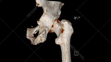 Radiology examination, Computed Tomography Volume Rendering examination of the  Hip joint